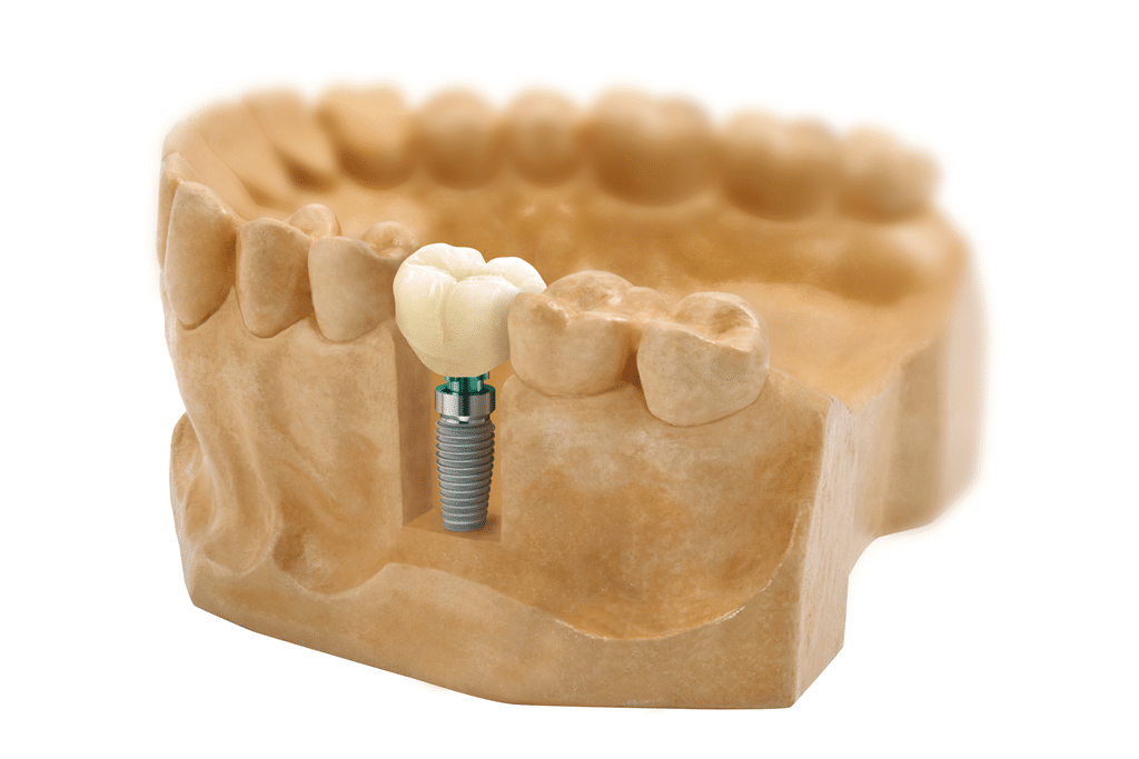 CCM sur implant : laboratoire de prothèse dentaire